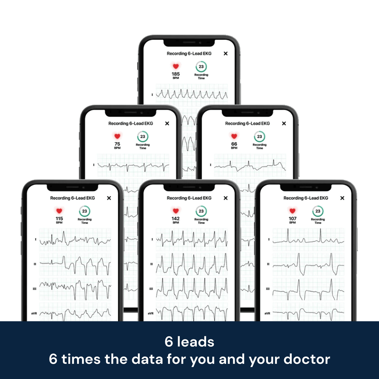  KardiaMobile 6-Lead Personal EKG Monitor – Six Views of The  Heart – Detects AFib and Irregular Arrhythmias – Instant Results in 30  Seconds – Works with Most Smartphones - FSA/HSA Eligible 